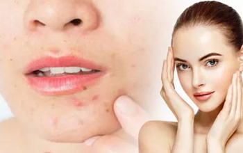 Skin Care Tips: चेहरे पर मुंहासे होने का कारण बन सकती हैं ये चीजें, आज ही इन से बनाएं दूरी...