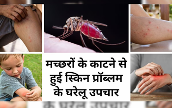 Mosquito Bite: मच्छर ने काट-काट कर स्किन पर निकाल दिए हैं दानें? ये 4 घरेलू उपचार तुरंत देंगे आपको आराम