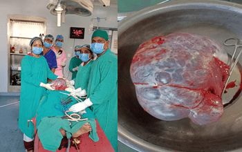 जिला चिकित्सालय में 3.8 किलो के ओवरी सिस्ट का हुआ सफल ऑपरेशन...