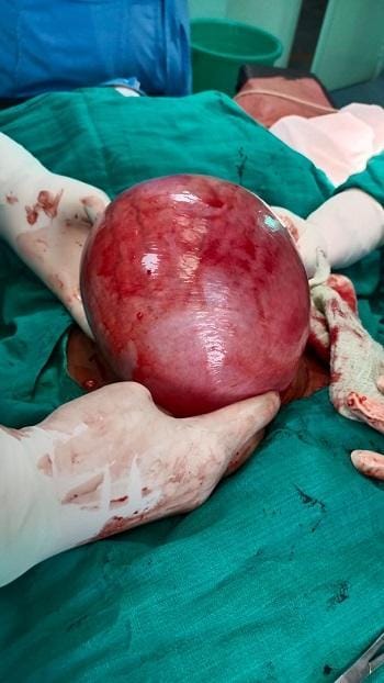 जिला चिकित्सालय दुर्ग में फाईब्राइड पीड़ित मरीज का सफल ऑपरेशन... 2 जिला चिकित्सालय दुर्ग में फाईब्राइड पीड़ित मरीज का सफल ऑपरेशन...