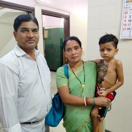 बीएसपी अस्पताल के बर्न यूनिट ने पुनः एक बार साबित की अपनी श्रेष्ठता 4 साल के बच्चे का किया सफल स्किन ग्राफ्टिंग...