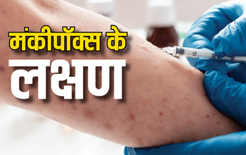 Mpox Symptoms: इन 7 मामूली लक्षणों के साथ बॉडी को कंकाल बना रहा एमपॉक्स, ले ली 570 जान, बचने का सिर्फ एक रास्ता...