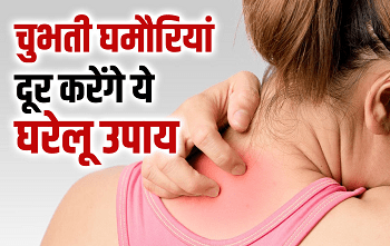 गर्मी में चुभती घमौरियां करे परेशान तो अपनाएं ये आसान उपाय, जल्द ही दाने होंगे दूर, खुजली से मिलेगा छुटकारा... 1 गर्मी में चुभती घमौरियां करे परेशान तो अपनाएं ये आसान उपाय, जल्द ही दाने होंगे दूर, खुजली से मिलेगा छुटकारा...
