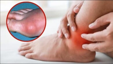 यूरिक एसिड बढ़ने पर शरीर में दिखते हैं ये लक्षण, जान लें कंट्रोल करने के उपाय...