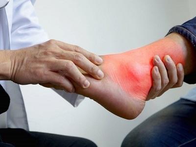 क्या यूरिक एसिड में आम खा सकते हैं या नहीं? डॉक्टर से जानें...